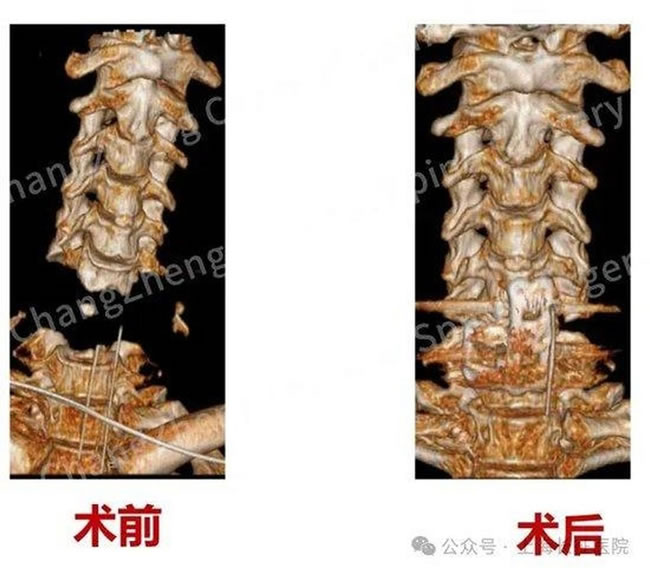 世上罕见…男「身首离断」濒死 上海长征医院靠1物救回